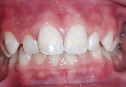 儿童牙齿清洁法宝 牙间隙色素清除有妙招